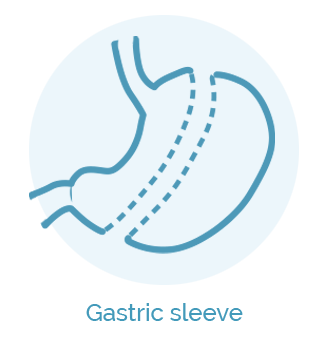 gastric sleeve