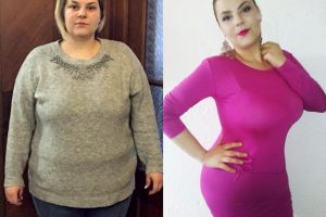 Bariatric-surgery-before-and-after11