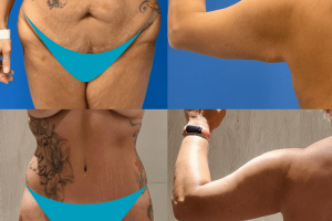 Circumferential tummy tuck + Waist liposuction + Arm lift