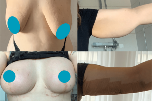 Breast lift with implants + Arm lift
