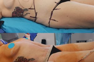 Circumferential tummy tuck + Waist liposuction