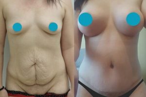 Tummy tuck + Breast enlargement