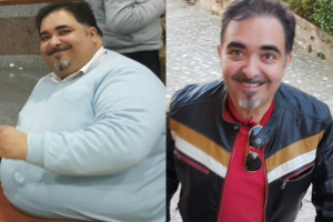 bariatric-before-after-3-2