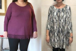 bariatric-before-after-5
